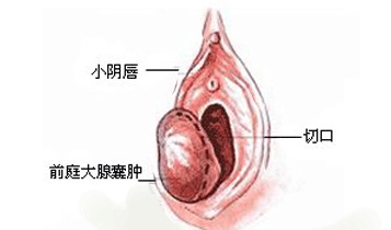 前庭大腺囊肿