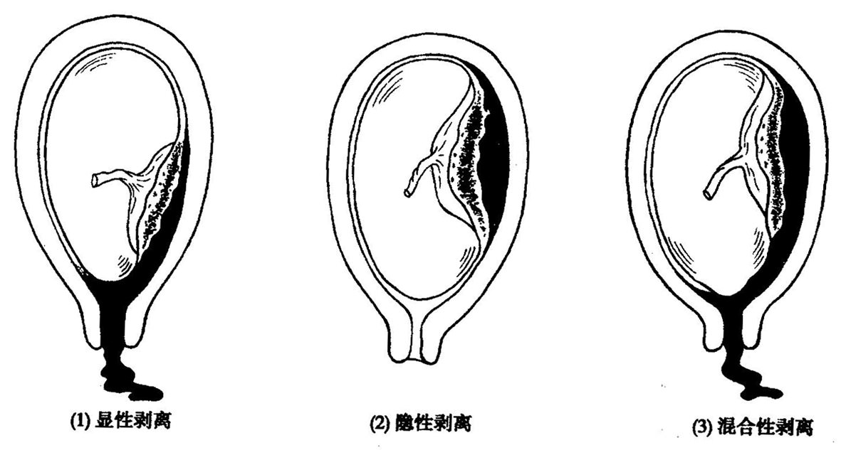 胎盘早剥